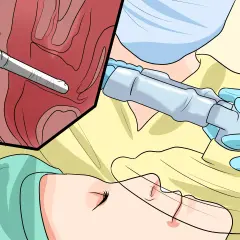 Chirurgie endoscopique pour une cystocèle grade 2. Un instrument médical est inséré dans une zone anatomique.