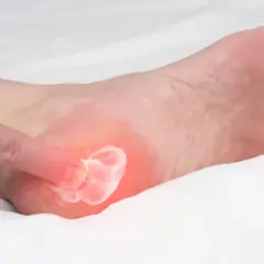 Application d'une crème sur une zone rouge et douloureuse du talon, suggérant une aponévrosite plantaire qui ne guérit pas.