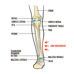 Anatomie du tibia avec une zone douloureuse marquée, typique de la douleur au tibia chez un débutant en course à pied.