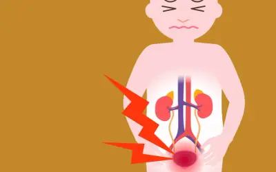 Douleur intense au bas du dos et à la vessie, suggérant une sciatique et une vessie hyperactive. L'image montre un schéma du système urinaire avec des éclairs rouges.