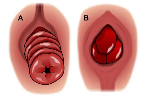 Illustration A montre une descente d'organes chez l'homme avec des plis distincts. Illustration B montre une masse rouge, possiblement une hernie.