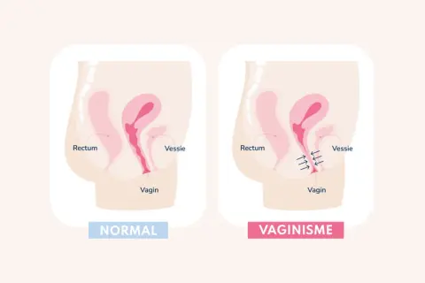 Comparaison anatomique : vagin normal et vaginisme. Le vaginisme peut causer une douleur au plancher pelvien due à une contraction involontaire.