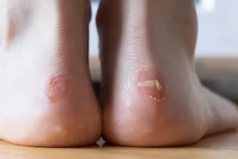 Gros plan sur des ampoules aux talons, une question courante est : combien de temps dure une ampoule au pied ?