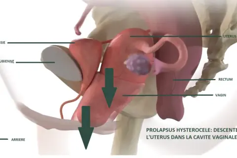 Illustration anatomique montrant le prolapsus utérin, une descente de l'utérus causant une fatigue pelvienne. La vessie et le rectum sont aussi visibles.