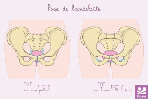 Schéma comparant deux techniques de pose de bandelette pour l'incontinence à l'effort : TVT (passage sus-pubien) et TOT (passage transobturateur).