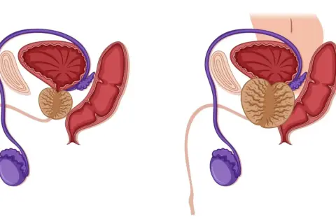 Schéma comparatif du système urinaire masculin. La prostate agrandie peut causer une fuite urinaire après grattage.