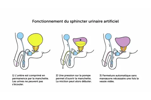 Schéma du fonctionnement d'un sphincter urinaire artificiel, une solution pour les fuites urinaires après prostatectomie totale.