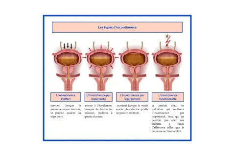 Illustration des types d'incontinence urinaire. L'incontinence d'effort survient quand on tousse ou éternue, un peu comme quand j'éternue je fais pipi.