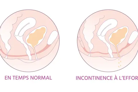 Schéma comparant le soutien normal de la vessie et l'incontinence à l'effort. Le tampon support de vessie est essentiel pour un bon maintien.