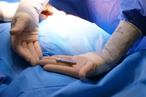 Main chirurgicale : un petit implant, le stimulateur du nerf sacré pour la vessie, est tenu dans une main gantée. Il peut y avoir des inconvénients.