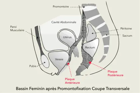 Coupe transversale du bassin féminin après promontofixation, montrant l'utérus, la vessie, le rectum et les plaques antérieures/postérieures. Peut aider à comprendre les douleurs lombaires.