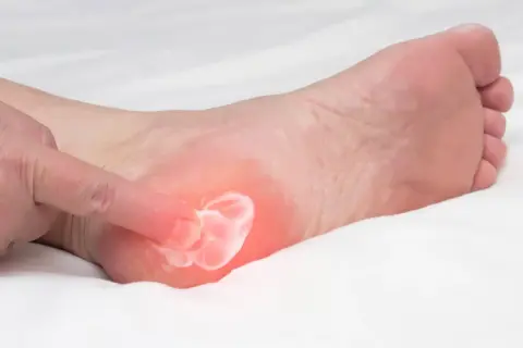 Application d'une crème sur une zone rouge et douloureuse du talon, suggérant une aponévrosite plantaire qui ne guérit pas.