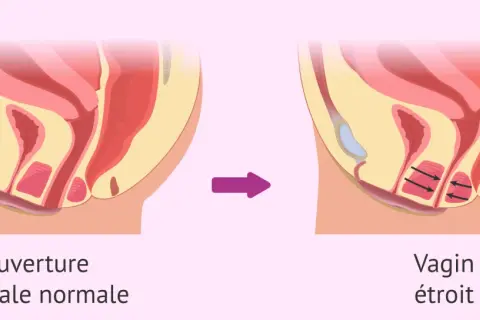 Illustration anatomique montrant une ouverture vaginale normale puis un vagin étroit suite à une contraction involontaire du périnée.