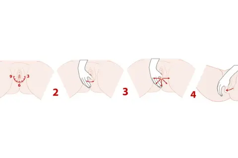 Étapes illustrant le massage du périnée : 1. Zone marquée. 2. Pression douce. 3. Mouvements variés. 4. Étirement.
