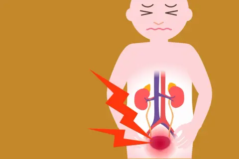 Douleur intense au bas du dos et à la vessie, suggérant une sciatique et une vessie hyperactive. L'image montre un schéma du système urinaire avec des éclairs rouges.