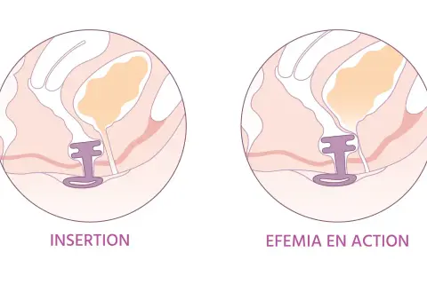 Illustration montrant l'insertion d'un dispositif pour le traitement naturel de la vessie irritée.