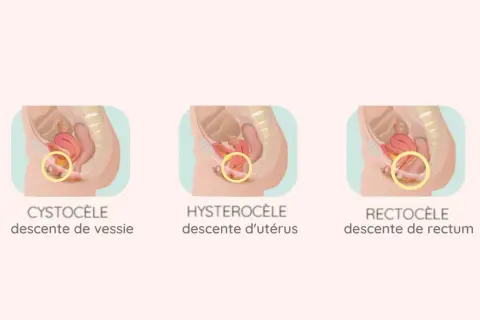 Illustration médicale montrant un prolapsus de la vessie stade 2 (cystocèle), une descente de l'utérus (hystérocèle) et une descente du rectum (rectocèle).