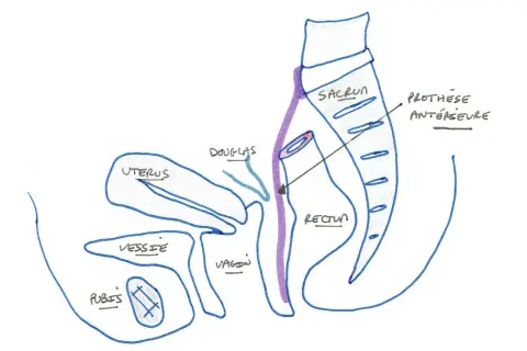 Schéma pelvien montrant l'utérus, la vessie, le vagin, le rectum, le sacrum et une prothèse antérieure. Illustration pour la convalescence après opération d'un prolapsus.