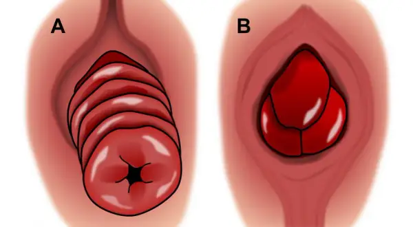 Illustration A montre une descente d'organes chez l'homme avec des plis distincts. Illustration B montre une masse rouge, possiblement une hernie.