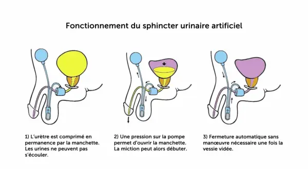 Schéma du fonctionnement d'un sphincter urinaire artificiel, une solution pour les fuites urinaires après prostatectomie totale.