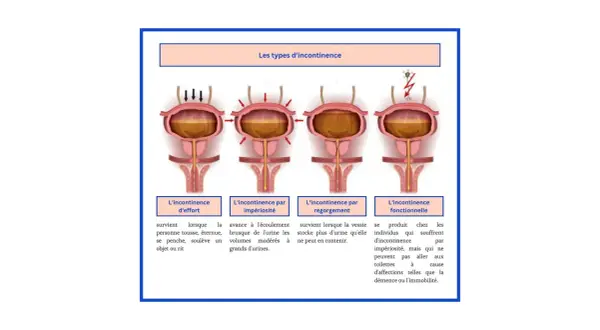 Illustration des types d'incontinence urinaire. L'incontinence d'effort survient quand on tousse ou éternue, un peu comme quand j'éternue je fais pipi.