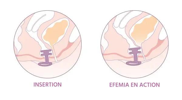 Illustration montrant l'insertion d'un dispositif pour le traitement naturel de la vessie irritée.