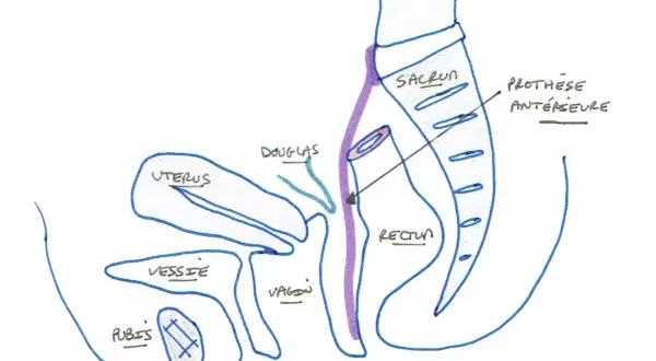 Schéma pelvien montrant l'utérus, la vessie, le vagin, le rectum, le sacrum et une prothèse antérieure. Illustration pour la convalescence après opération d'un prolapsus.