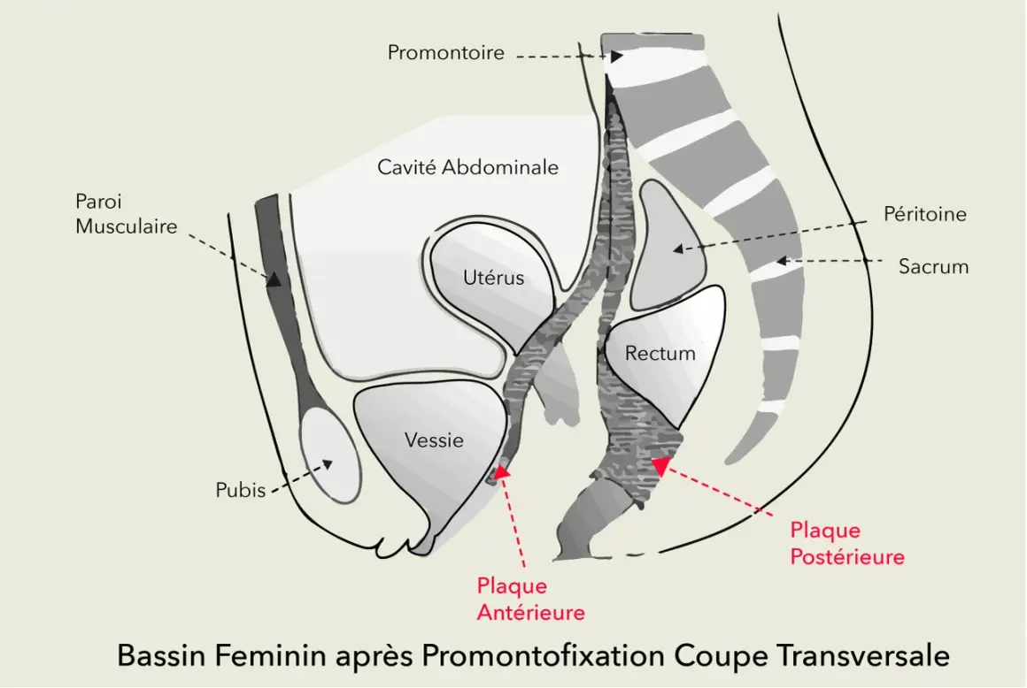 Coupe transversale du bassin féminin après promontofixation, montrant l'utérus, la vessie, le rectum et les plaques antérieures/postérieures. Peut aider à comprendre les douleurs lombaires.