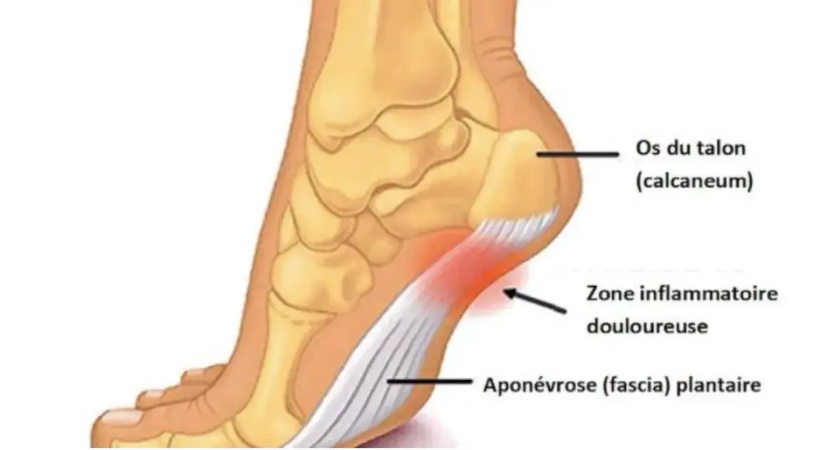 Anatomie du pied montrant l'aponévrose plantaire enflammée. Une bonne alimentation peut aider à gérer l'aponévrosite plantaire.