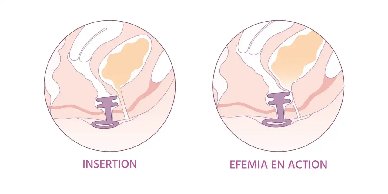 Vessie irritée - solutions naturelles et rôle du périnée