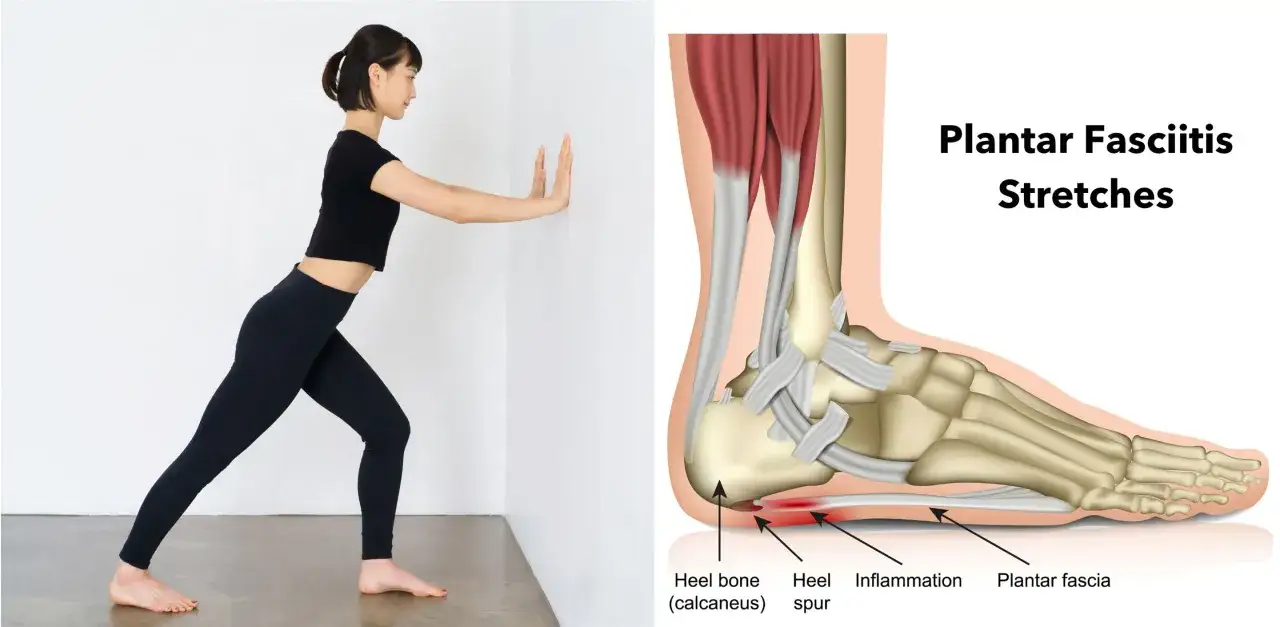 Femme s'étirant pour soulager une aponévrosite plantaire qui ne guérit pas. Illustration anatomique du pied montrant l'inflammation.