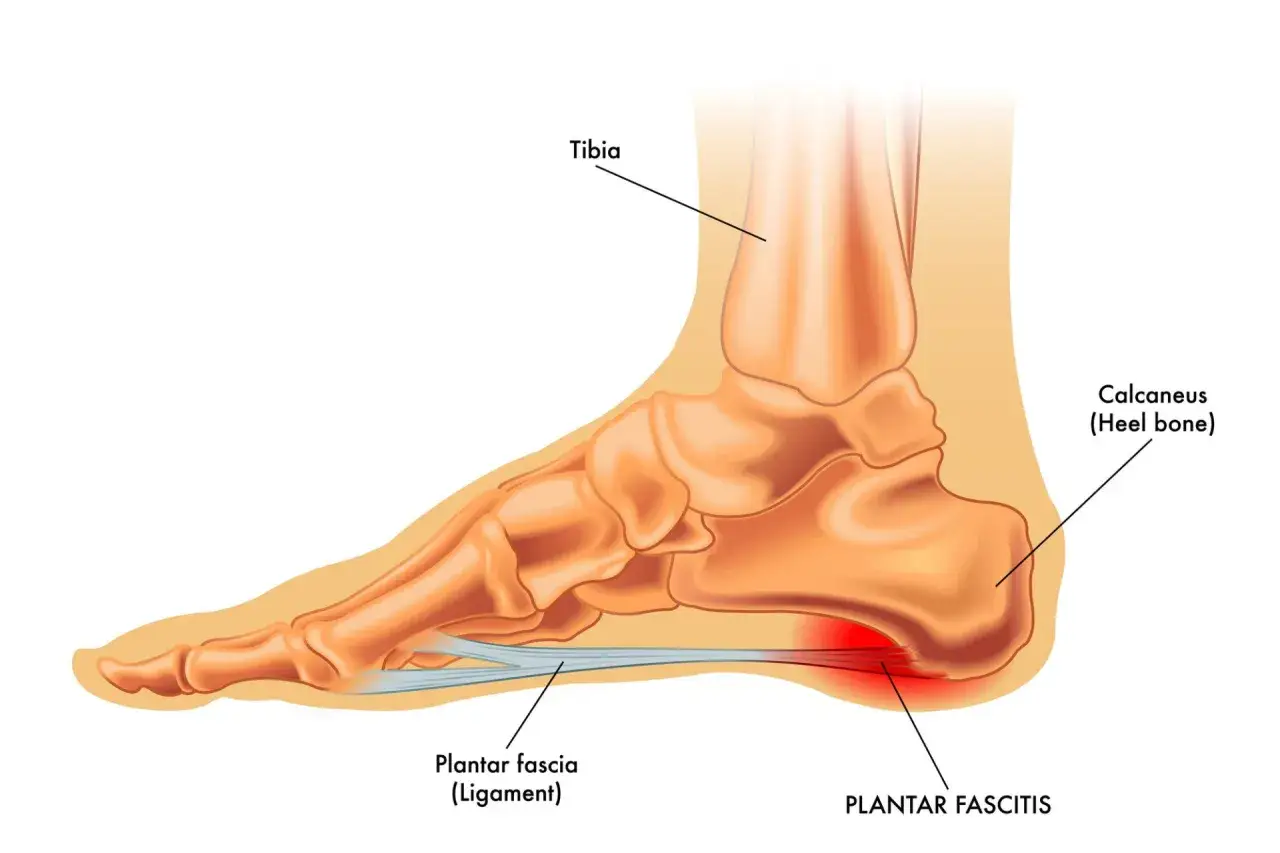Anatomie du pied montrant l'aponévrosite plantaire. Une alimentation équilibrée peut aider à gérer cette condition.