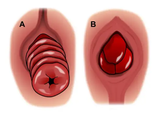 Descente d’organe chez l’homme - reconnaître un prolapsus rectal