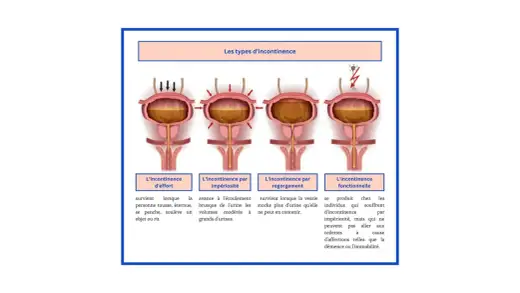 Fuite d’urine en éternuant ? Comprendre l’incontinence d’effort