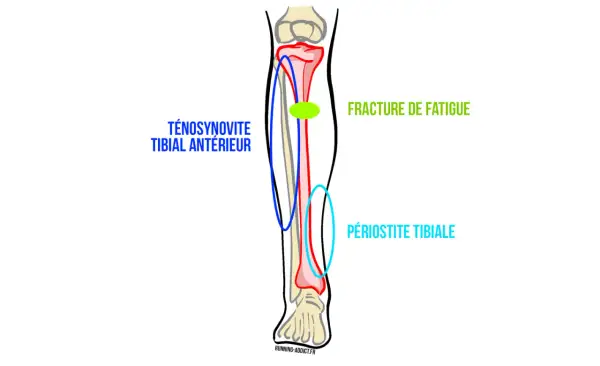Schéma du tibia montrant les causes de douleur : fracture de fatigue, périostite tibiale et ténosynovite du tibial antérieur.