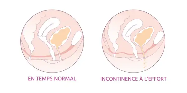 Schéma comparant le soutien normal de la vessie et l'incontinence à l'effort. Le tampon support de vessie est essentiel pour un bon maintien.