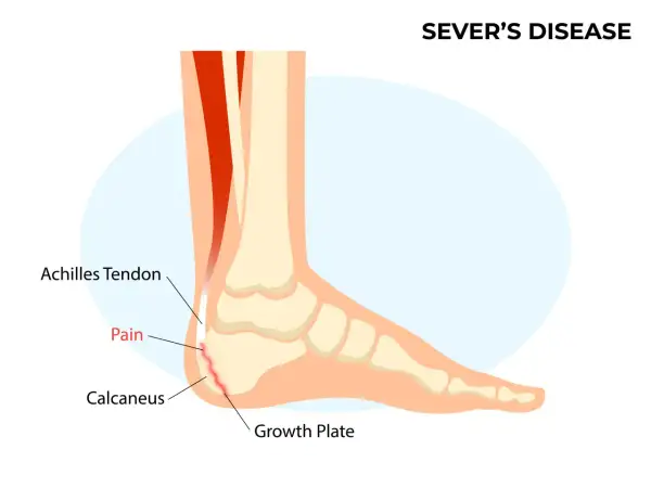 Schéma du pied montrant la maladie de Sever : douleur au talon (calcanéus) due à l'inflammation de la plaque de croissance, affectant le tendon d'Achille.