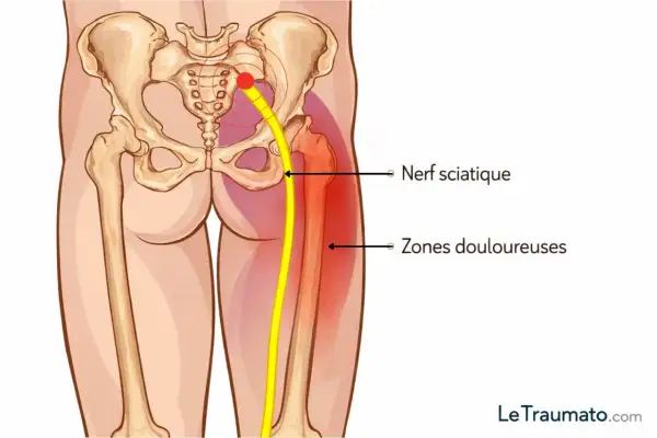 Illustration anatomique montrant le nerf sciatique et les zones douloureuses associées au symptôme de sciatique jambe droite.