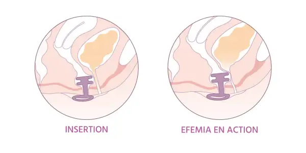 Illustration montrant l'insertion d'un dispositif pour le traitement naturel de la vessie irritée.