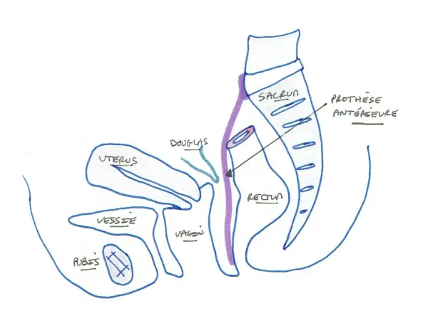 Schéma pelvien montrant l'utérus, la vessie, le vagin, le rectum, le sacrum et une prothèse antérieure. Illustration pour la convalescence après opération d'un prolapsus.